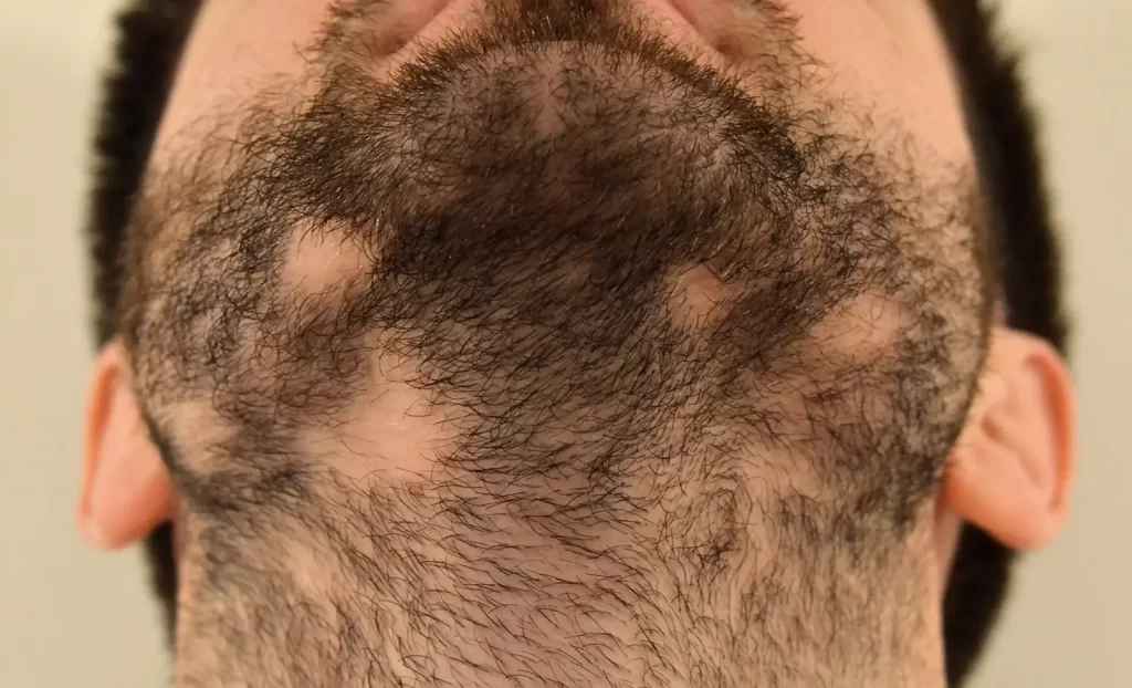 Patchy Beard / Patchy Scalp