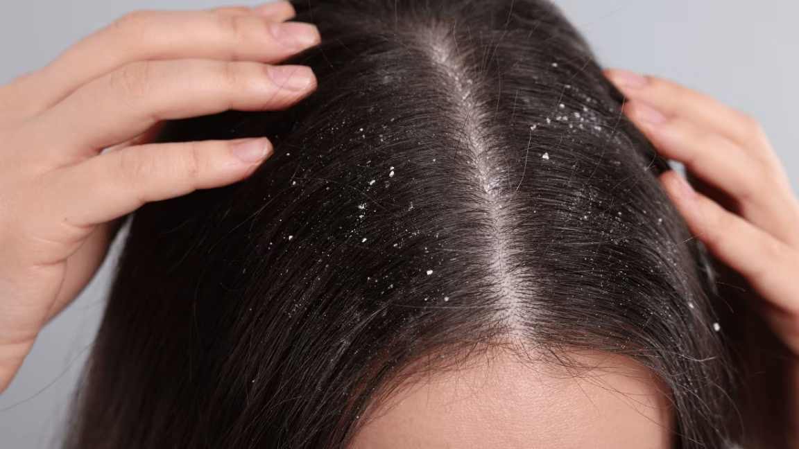 Dandruff / Scalp Issues