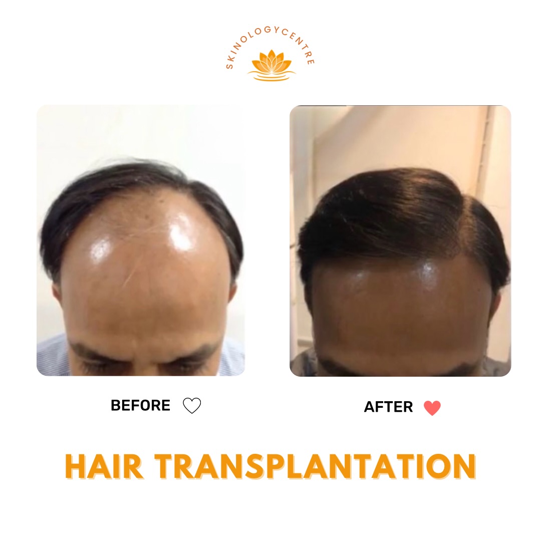 Hair Transplant Results - Before and After - Case 1