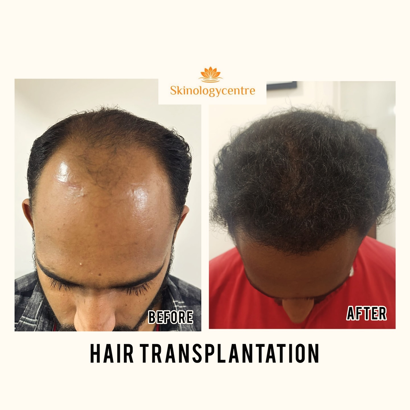 Hair Transplant Results - Before and After - Case 2