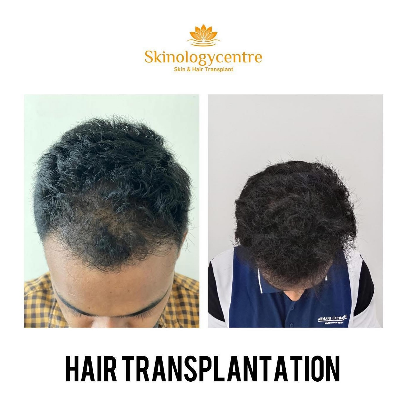 Hair Transplant Results - Before and After - Case 3