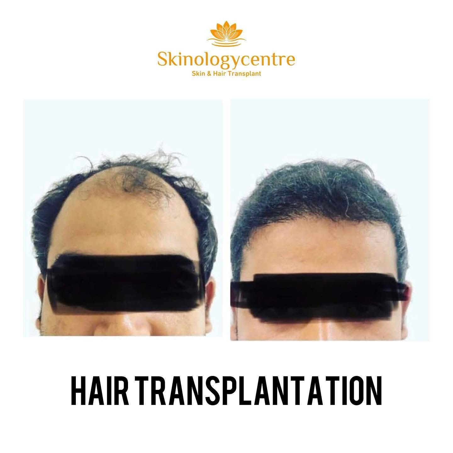 Hair Transplant Results - Before and After - Case 4