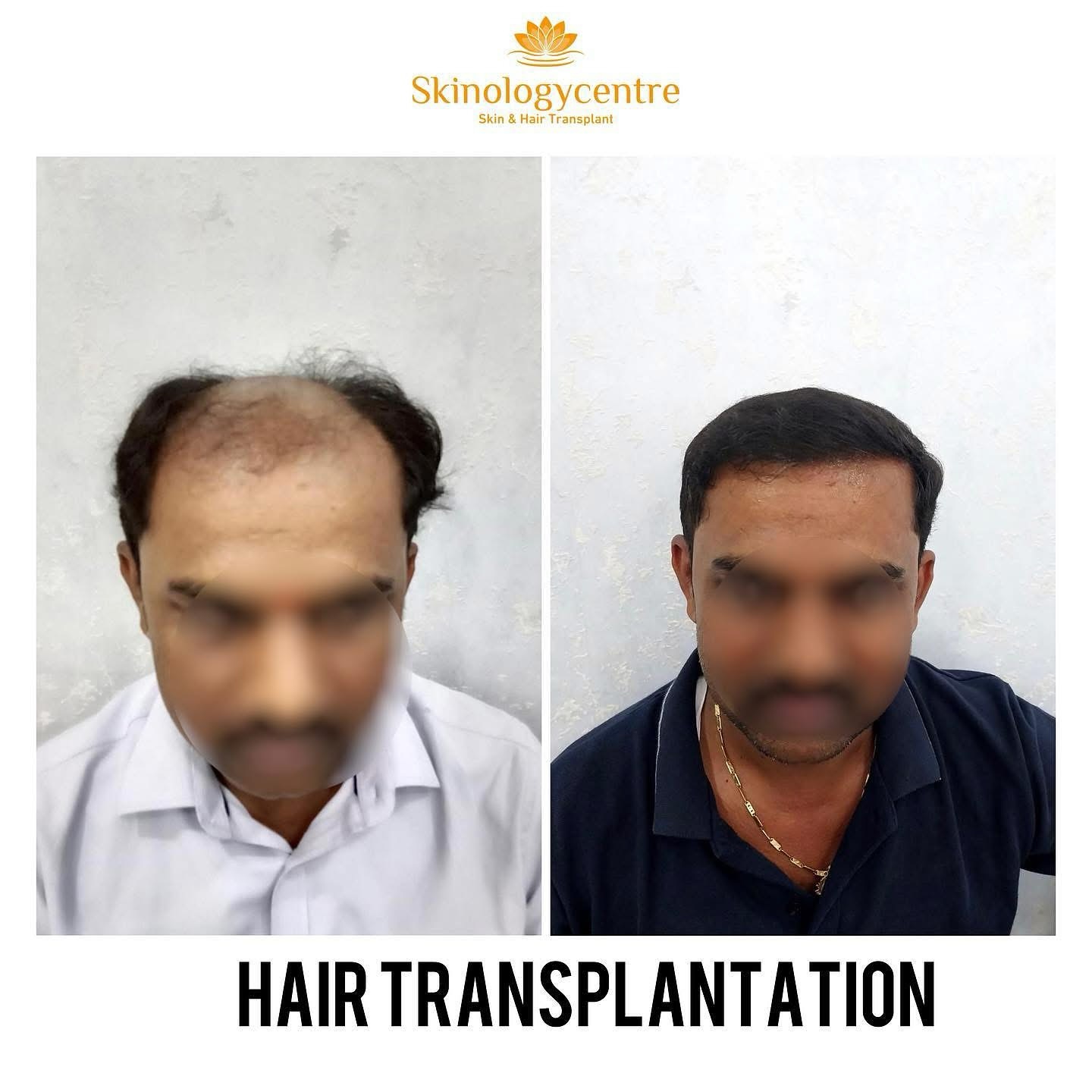 Hair Transplant Results - Before and After - Case 5