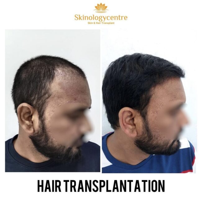 Before and after comparison for hair transformation