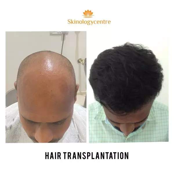 Before and after comparison for hair transformation