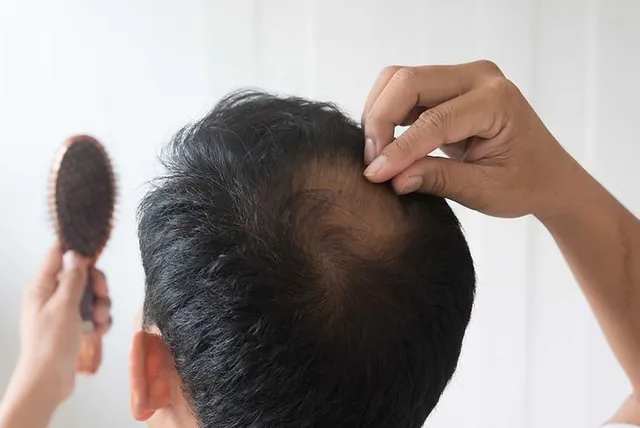 Male Pattern Baldness