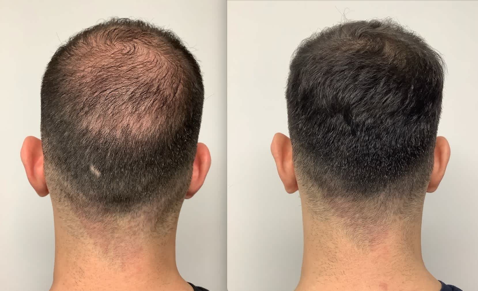 Severe Hair Loss